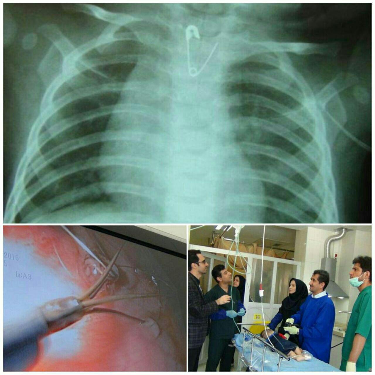 سنجاق قفلی بلعیده شده از مری کودک 6 ماهه خارج شد + تصاویر