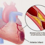 علائم مهم حمله قلبی؛ سکته مغزی و آنژین صدری