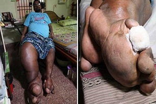 پاهای 100 کیلویی و عجیب مرد هندی+ عکس