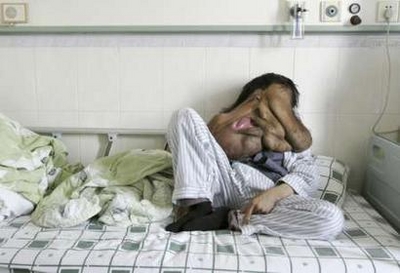 ماجرای عجیب زشت ترین بیمار دنیا + تصاویر