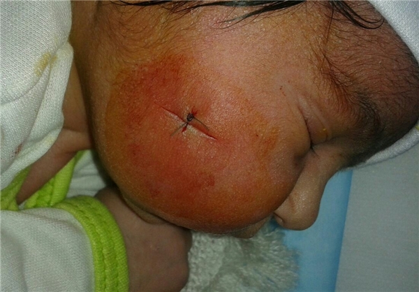 بازهم برخورد تیغ جراحی به نوزاد در عمل سزارین حادثه آفرید+ تصاویر