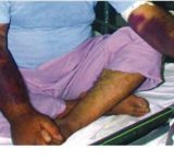 بیماری تب کریمه کنگو در مازندران کنترل شد 