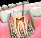 پیشگیری از خرابی دندان‌ها چگونه؟